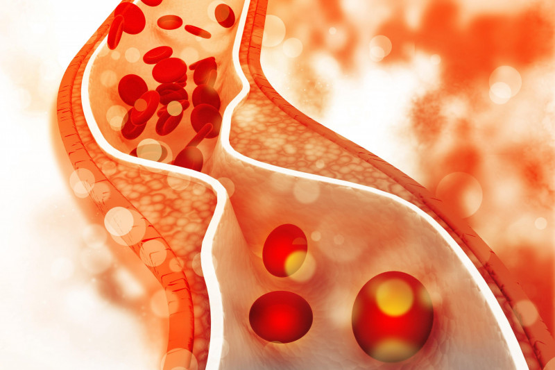 Image of blocked arteries